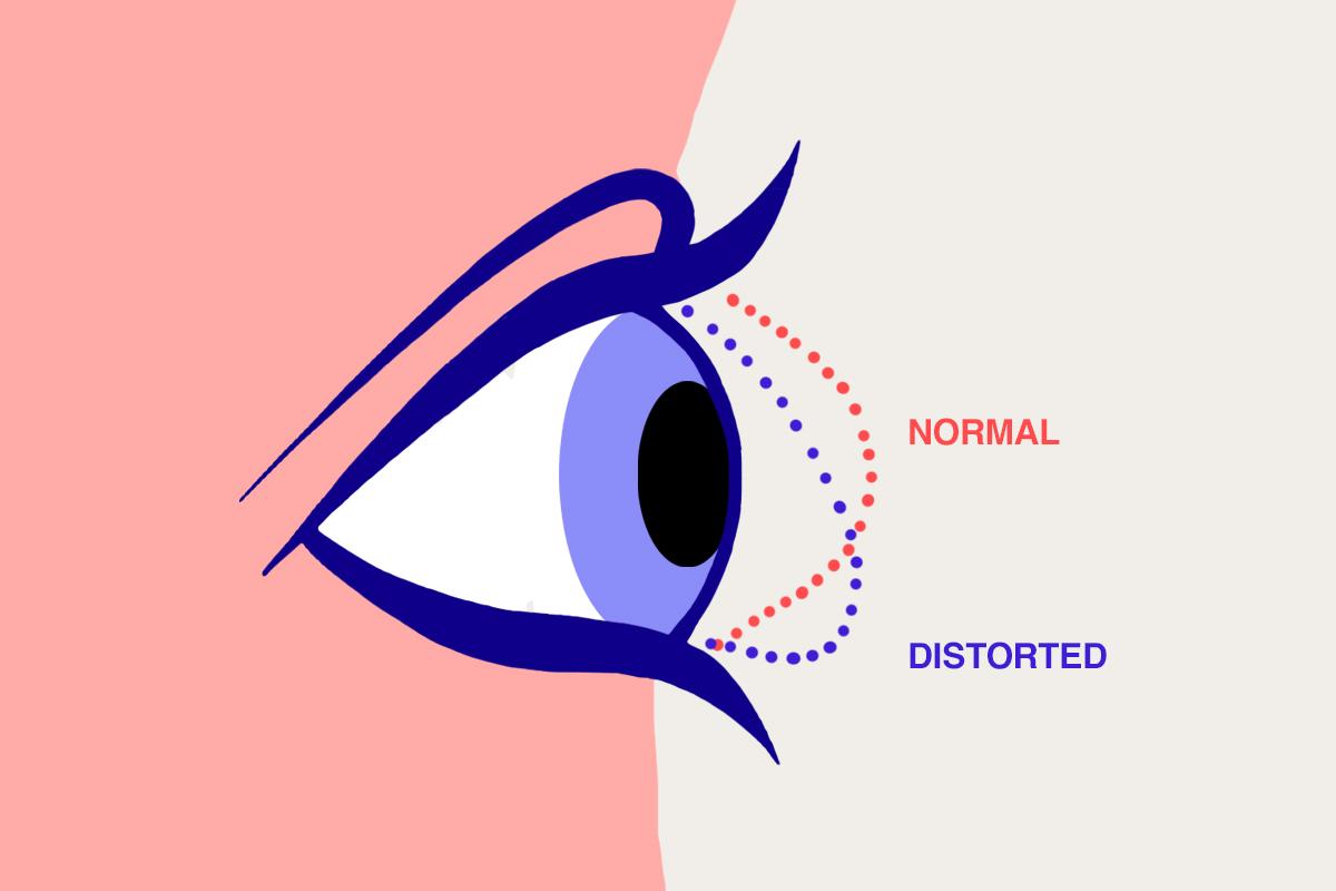 An eye with dotted lines to show corneal distortion, a hidden danger of sleep masks.